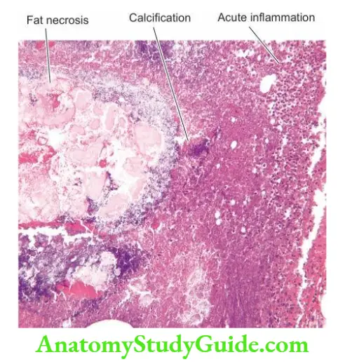 The Liver, Biliary Tract and Exocrine Pancreas Acute pancreatitis.