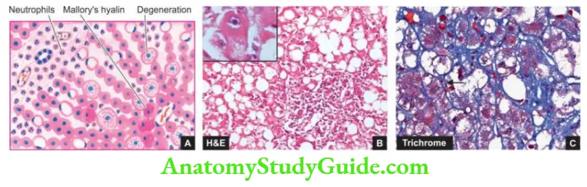 The Liver, Biliary Tract and Exocrine Pancreas Alcoholic hepatitis (Steatohepatitis) Liver cells show ballooning degeneration and fatty change Chickenwire creeping fibrosis is highlighted in