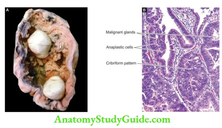The Liver, Biliary Tract and Exocrine Pancreas Carcinoma gallbladder.