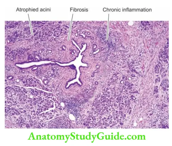 The Liver, Biliary Tract and Exocrine Pancreas Chronic pancreatitis.