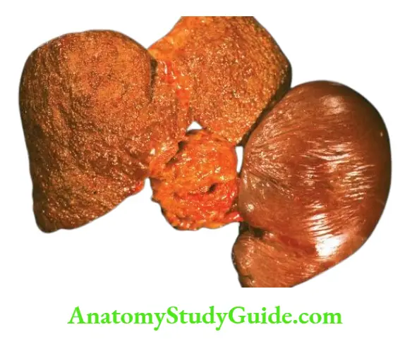 The Liver, Biliary Tract and Exocrine Pancreas Cirrhosis of the liver with splenomegaly.