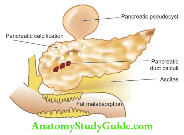 The Liver, Biliary Tract and Exocrine Pancreas Complications of chronic pancreatitis.