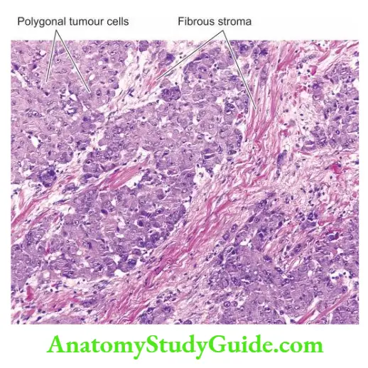 The Liver, Biliary Tract and Exocrine Pancreas Fibrolamellar carcinoma liver.