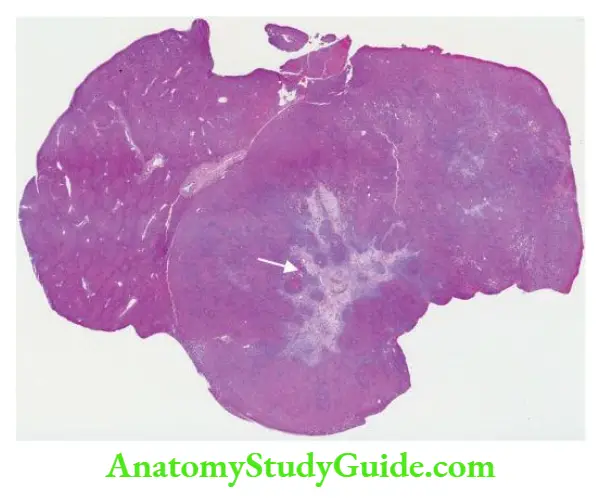 The Liver, Biliary Tract and Exocrine Pancreas Focal nodular hyperplasia.