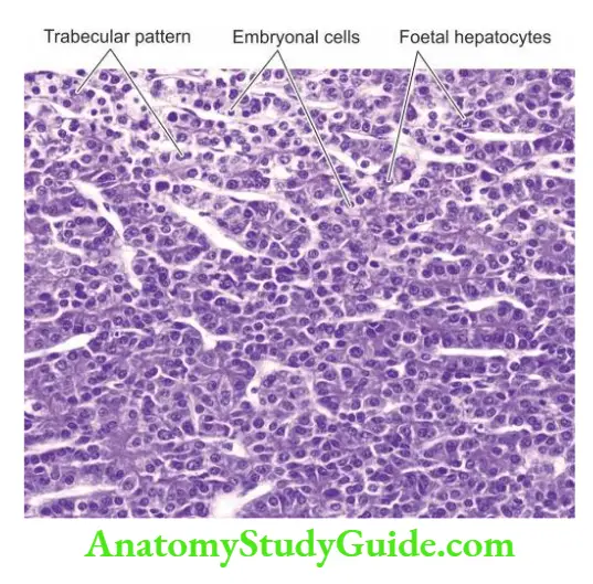 The Liver, Biliary Tract and Exocrine Pancreas Hepatoblastoma.