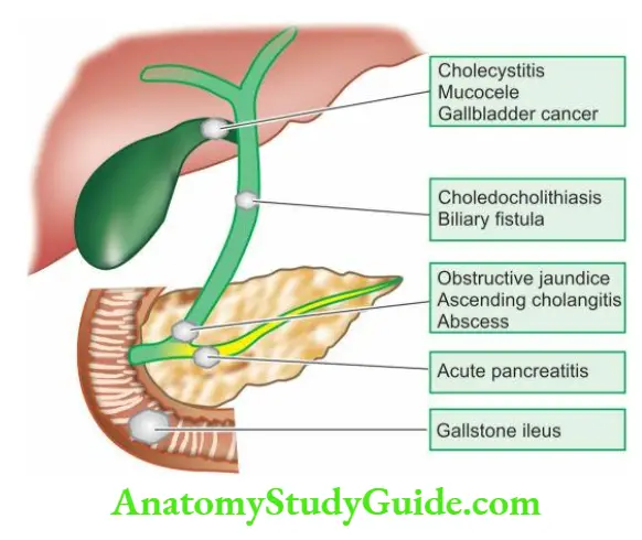 The Liver, Biliary Tract and Exocrine Pancreas Major clinical effects and complications of gallstones