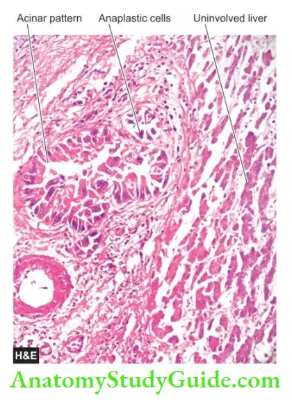 The Liver, Biliary Tract and Exocrine Pancreas Metastatic deposits from adenocarcinoma in the liver.