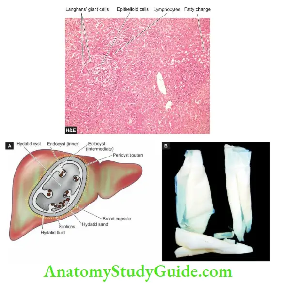 The Liver, Biliary Tract and Exocrine Pancreas Miliary tuberculosis liver,Hydatid cyst in the live The cyst wall is composed of whitish membrane resembling the membrane of a hard