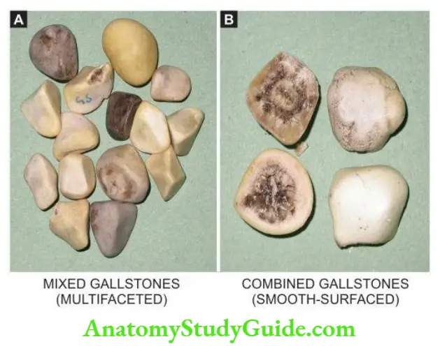 The Liver, Biliary Tract and Exocrine Pancreas Mixed and combined gallstones