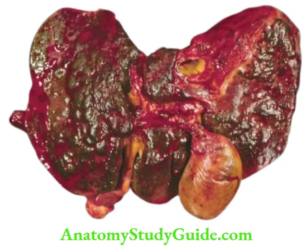 The Liver, Biliary Tract and Exocrine Pancreas Submassive hepatic necrosis