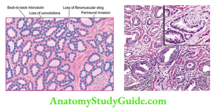 The Male Reproductive System and Prostate Carcinoma of the prostate.