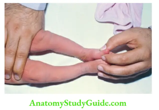 The Musculoskeletal System Bowed legs (genu varum). It is common and physiological during first 2 years of life.