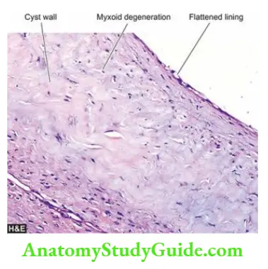 The Musculoskeletal System Cyst of ganglion. The cyst wall is composed of dense connective tissue lined internally by flattened lining. The cyst