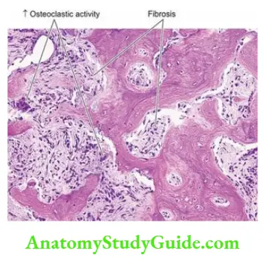 The Musculoskeletal System Osteitis fibrosa in hyperparathyroidism.