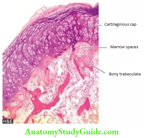 The Musculoskeletal System Osteochondroma. The overlying cap shows mature cartilage cells covering the underlying mature lamellar bone