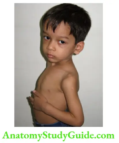 The Musculoskeletal System Pigeon-shaped chest with wide wrists in a child with rickets.