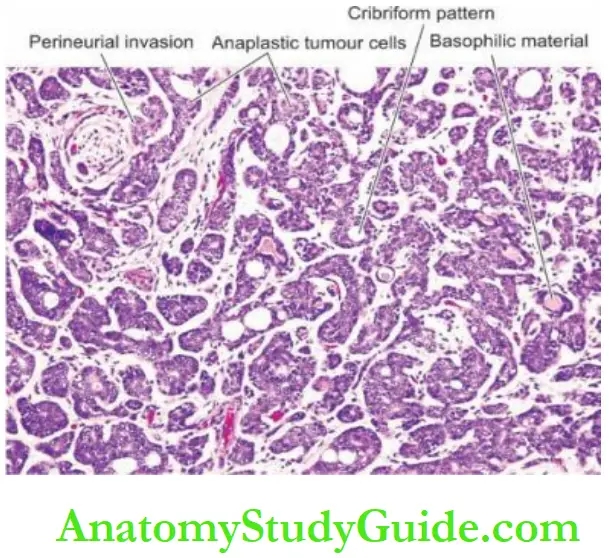 The Oral Cavity and Salivary Adenoid cystic carcinoma.