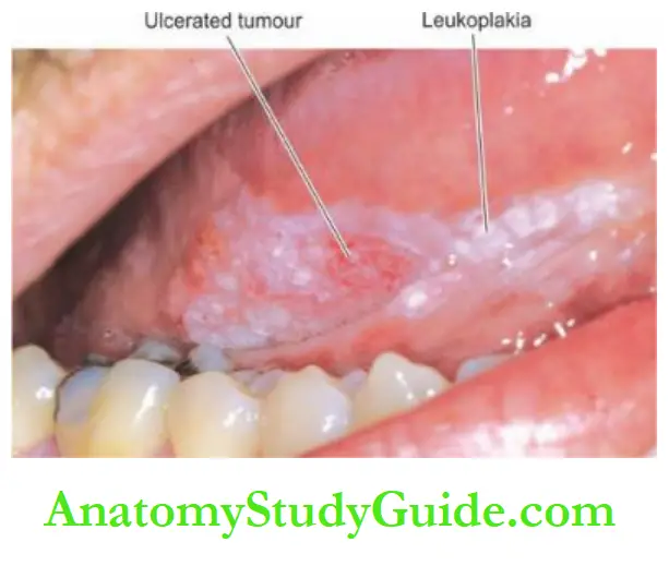 The Oral Cavity and Salivary Intraoral cancer
