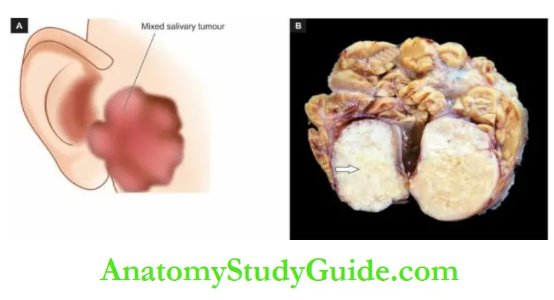 The Oral Cavity and Salivary Pleomorphic adenoma