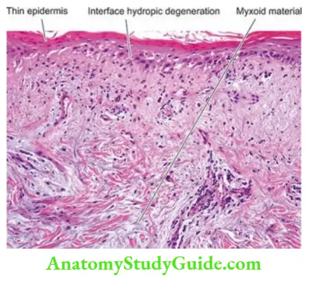 The Skin Discoid lupus erythematosus (DLE). T