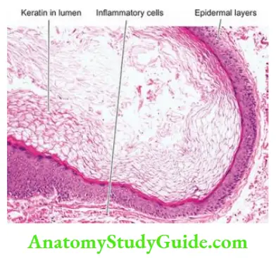 The Skin Epidermal inclusion cyst.