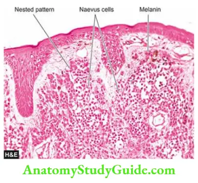 The Skin Intradermal naevus showing nests of naevus cells which are typically uniform and present in the dermis. Melanin