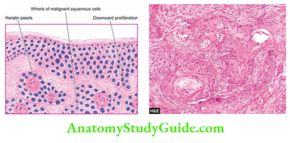 The Skin Microscopic features of well-differentiated squamous cell carcinoma.