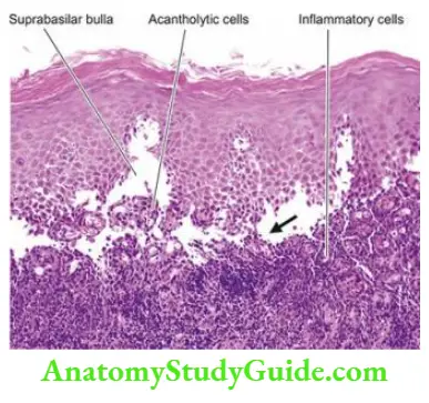 The Skin Location of bullae and vesicles in non-infectious bullous dermatoses.The Skin Location of bullae and vesicles in non-infectious bullous dermatoses.The Skin Location of bullae and vesicles in non-infectious bullous dermatoses.The Skin Location of bullae and vesicles in non-infectious bullous dermatoses.The Skin Location of bullae and vesicles in non-infectious bullous dermatoses.The Skin Location of bullae and vesicles in non-infectious bullous dermatoses.The Skin Location of bullae and vesicles in non-infectious bullous dermatoses.The Skin Location of bullae and vesicles in non-infectious bullous dermatoses.