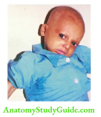 The Skin and its Appendages Alopecia, absence of eyebrows and eyelashes in an infant with anhidrotic ectodermal dysplasia.