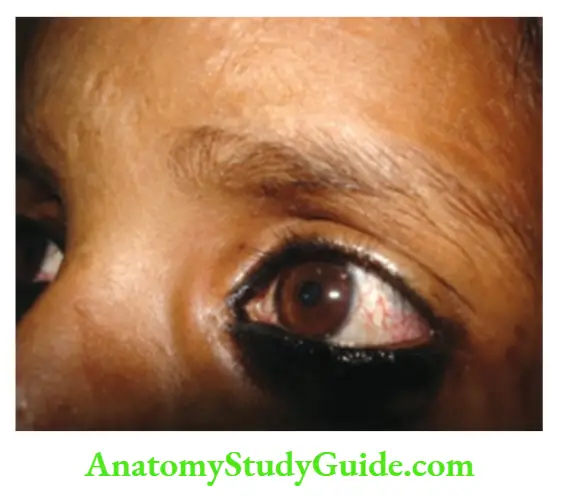 The Skin and its Appendages Characteristic telangiectasia over bulbar conjunctiva in a child with ataxia telangiectasia