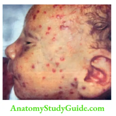 The Skin and its Appendages Classical blue berry muffins spots over the face due to dermal erythropoiesis in an infant with congenital CMV