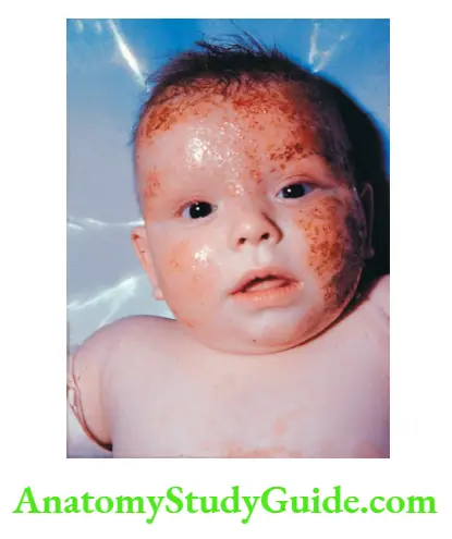 The Skin and its Appendages Infantile eczema