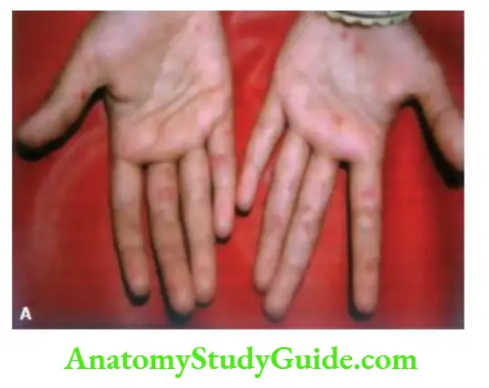 The Skin and its Appendages Papulovesicular skin lesions on the palms (A) and soles in a child