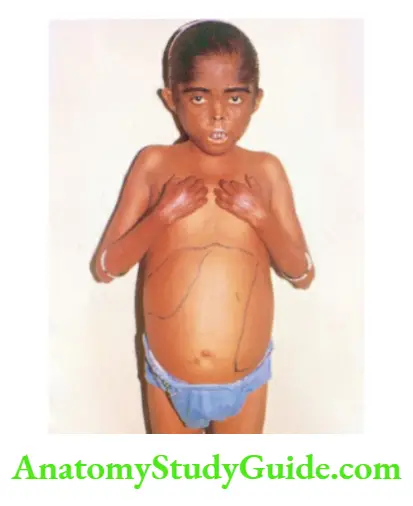 The Skin and its Appendages Photosensitive skin rash with pigmentation over the face and extremities with gross hepatosplenomegaly in a child