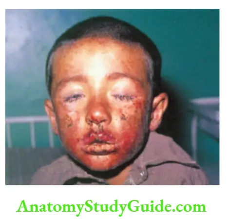 The Skin and its Appendages Stevens-Johnson syndrome due to intake of phenytoin.