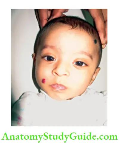 The Skin and its Appendages Strawberry nevus on the face of one-year-old infant.