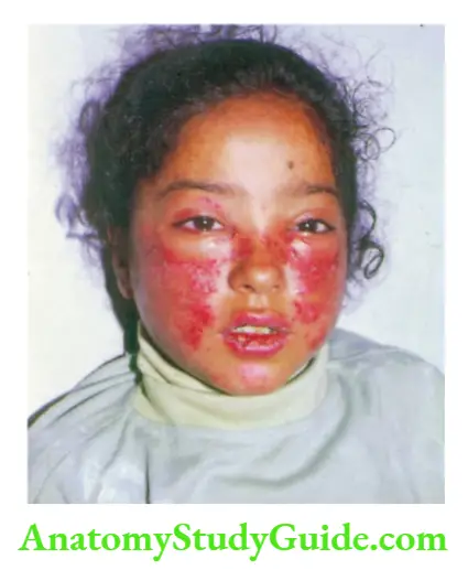The Skin and its Appendages Typical erythematous “butterfly” rash involving malar areas and extending over the bridge of the nose in an