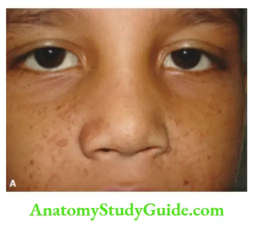 The Skin and its Appendages Typical flesh-colored papulonodular skin lesions of adenoma sebaceum on the cheeks and nose.