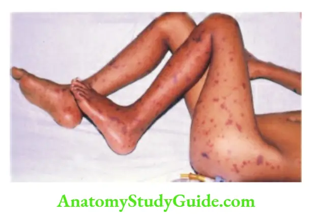 The Skin and its Appendages Typical irregular purpuric and gangrenous skin rash over the legs and buttocks in a child with fulminant