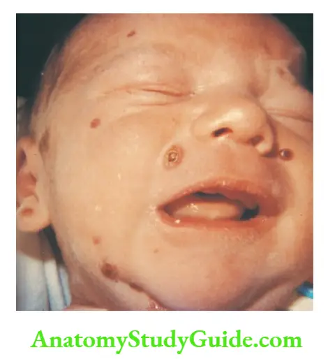 The Skin and its Appendages Typical lesions of chickenpox on the face of an infant with congenital varicella