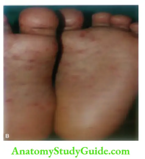 The Skin and its Appendages with hand-footand-mouth disease.