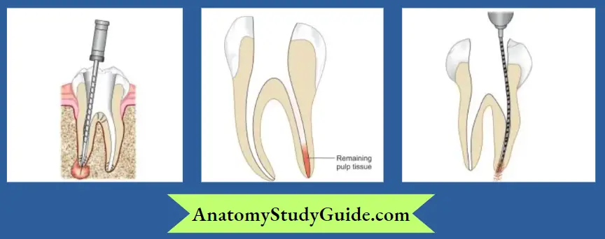 The mechanical injury