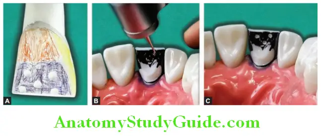 Tooth Preparation To Receive All Ceramic Crown depth orientation using number 6 round bur