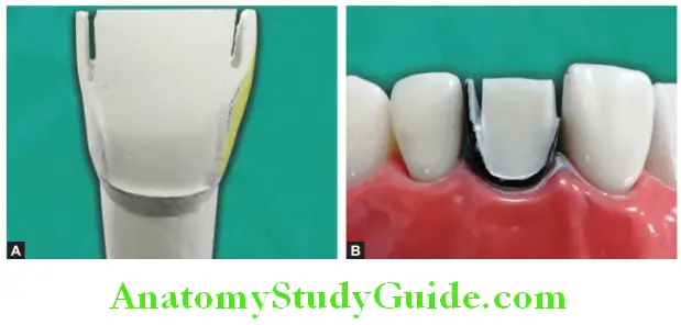 Tooth Preparation To Receive All Ceramic Crown formation of enamel lip