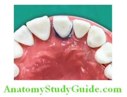 Tooth Preparation To Receive All Ceramic Crown formation of enamel lip