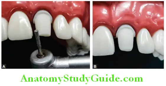 Tooth Preparation To Receive All Ceramic Crown make all the point and line angles rounded