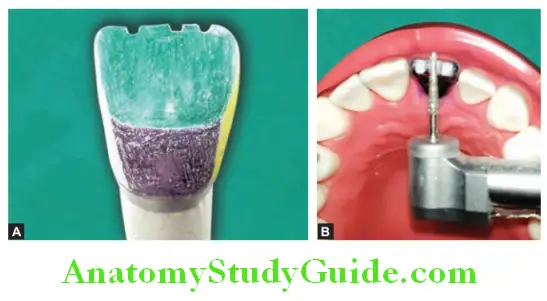 Tooth Preparation To Receive All Ceramic Crown place depth orientation grooves on incisal edge
