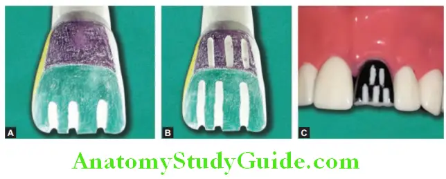 Tooth Preparation To Receive All Ceramic Crown placement of depth orienting grooves in two planes