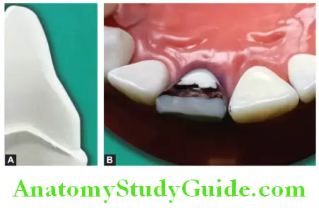 Tooth Preparation To Receive All Ceramic Crown preparation of lingual surface