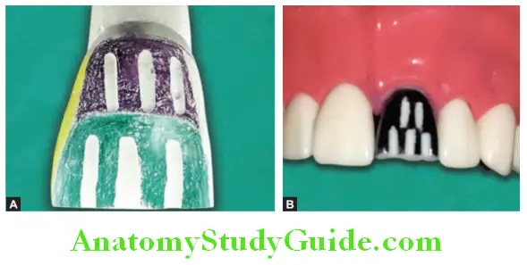 Tooth Preparation To Receive All Ceramic Crown reduction of incisal edge